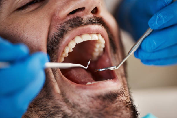 Best Emergency Dentist for Lost Fillings or Crowns in Owingsville, KY